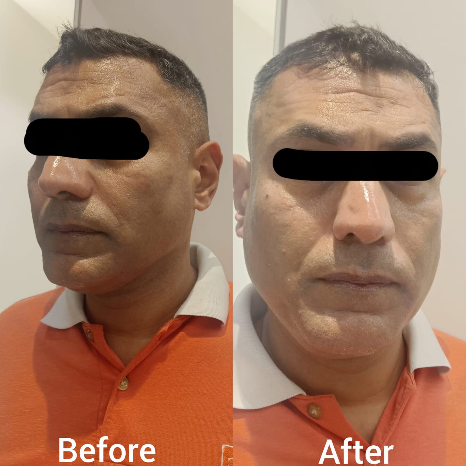 Anti-aging treatment - Before and After at Aura Clinic